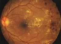 糖尿病性视网膜病变如何?