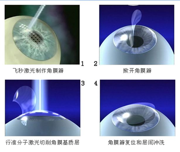 近视眼怎么提高视力