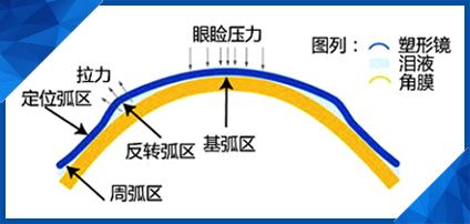 在昆明怎么纠正近视眼